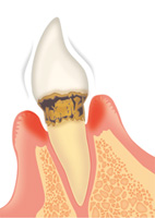 歯周病の進行具合