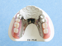 金属義歯